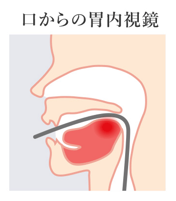 口からの胃内視鏡